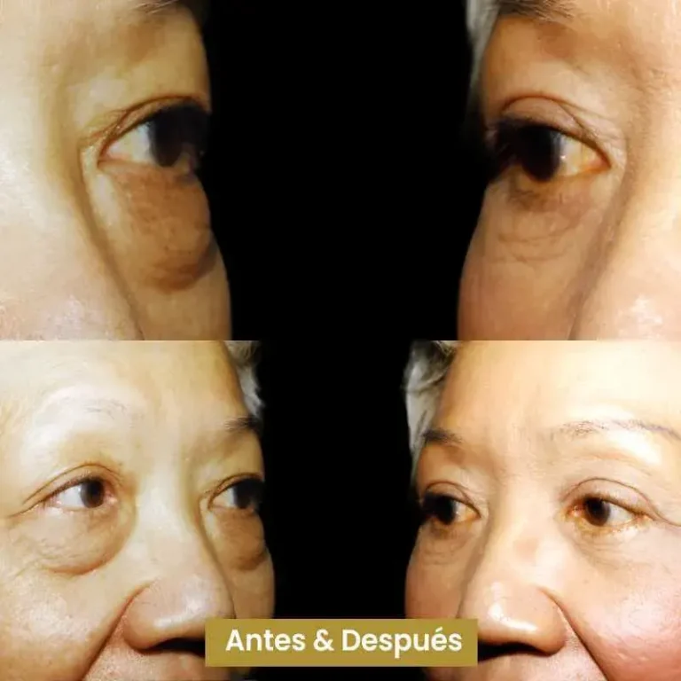 Blefaroplastia-1