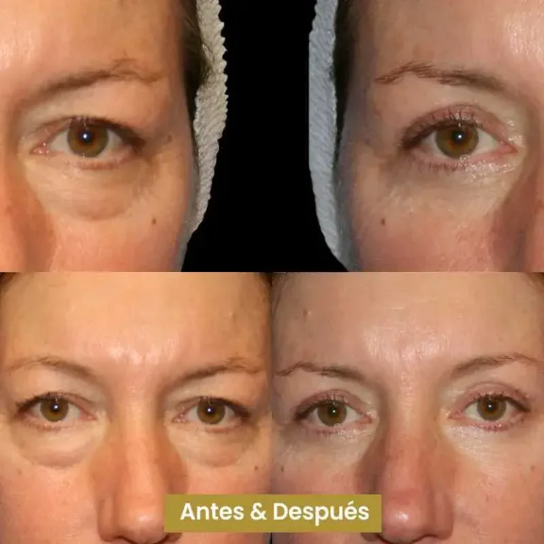 Blefaroplastia-2