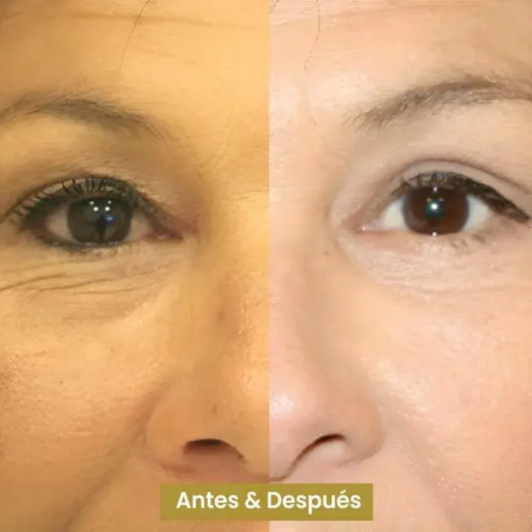 Blefaroplastia-3