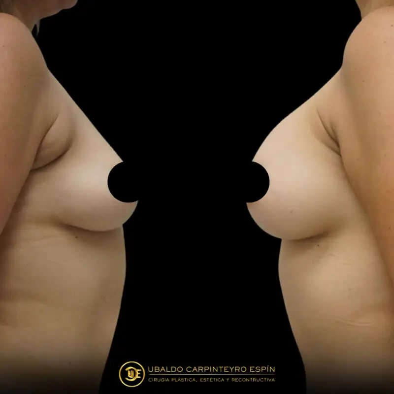 Busto-aumento-8