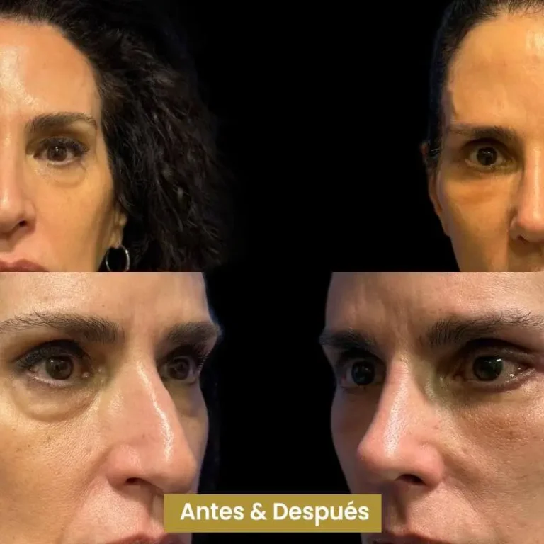 Blefaroplastia-4