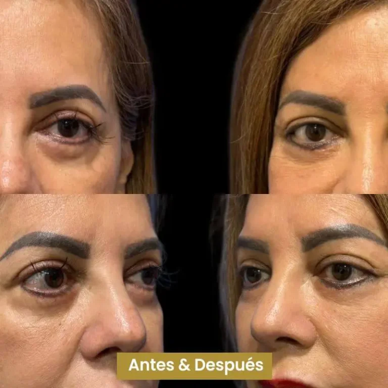 Blefaroplastia-5