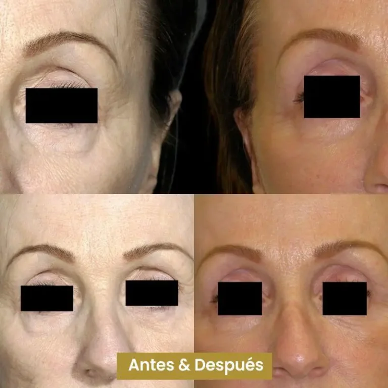 Blefaroplastia-6